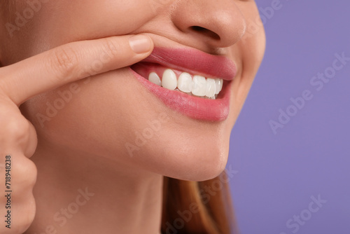 Woman showing her clean teeth on violet background, closeup. Space for text