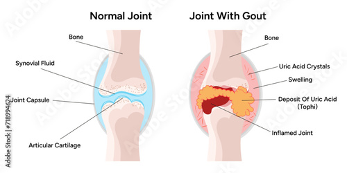 Medical infographic the gout arthritis and normal joints photo