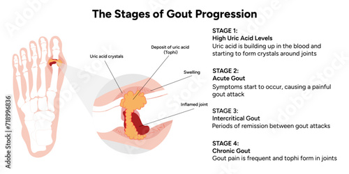 Medical information and infographic on the stages of gout progression 