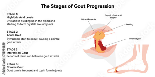 Medical information and infographic the stages of gout progression 