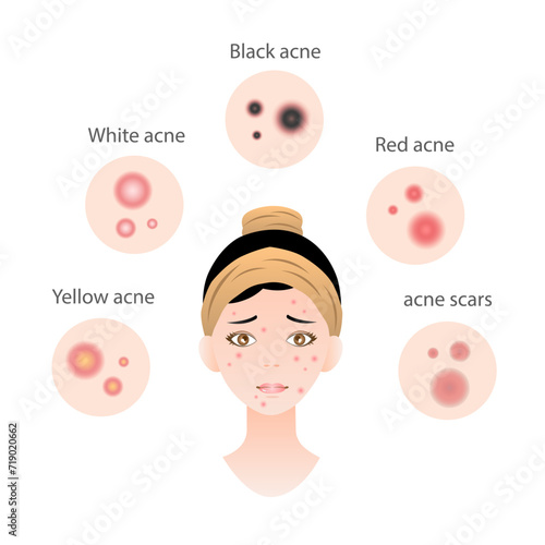 Illustration of woman with various types of acne for web and banner design.