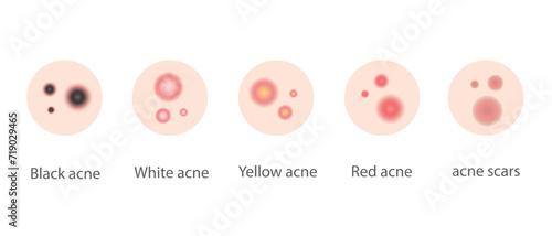 Illustration of various types of acne for web design and banners. photo