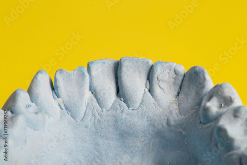 Blue plaster impression of a patient's dental jaw with crooked teeth and malocclusions on a yellow background. Manufacturing of braces to correct bite. View from above. Copy space for text photo