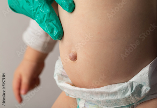 Doctor's hands in green medical gloves examine an umbilical hernia in a child, close-up. photo