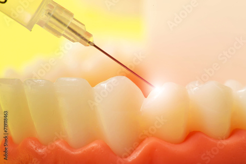 Injection of an anesthetic drug into the gum of a diseased tooth for treatment and surgery. Dental anesthesia in dentistry, freezing, macro. Copy space for text photo