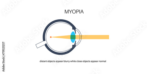 Nearsightedness eye disease