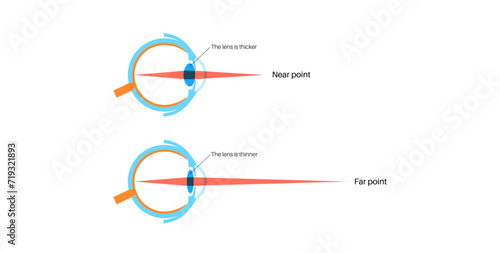 Eye accommodation poster