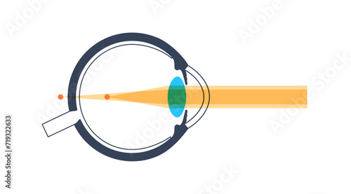 Astigmatism eye disease