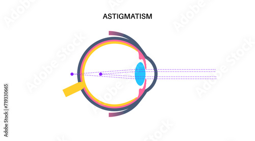 Astigmatism eye disease