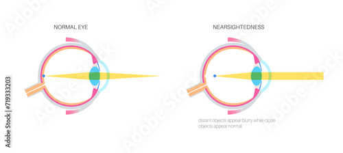 Normal eye and nearsightedness