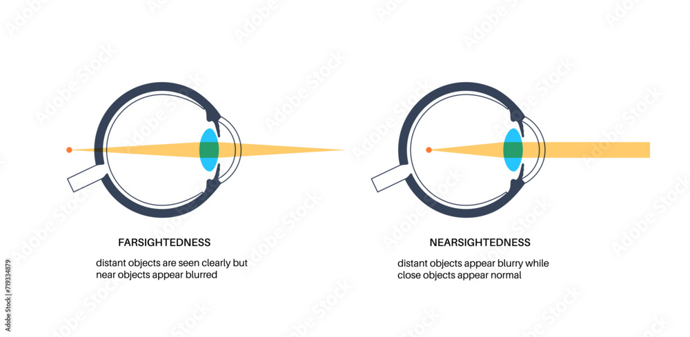 Farsightedness and nearsightedness Farsightedness and nearsightedness