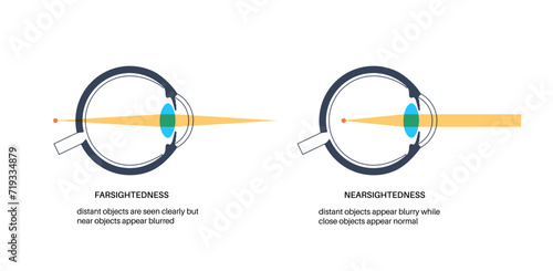 Farsightedness and nearsightedness