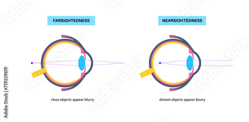 Farsightedness and nearsightedness photo
