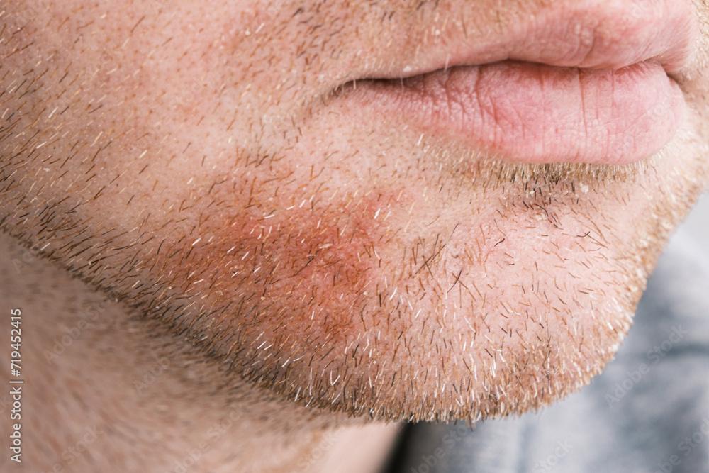 Seborrheic dermatitis or eczema on adult man face close up. Seborrheic dermatitis or eczema on adult man face close up.