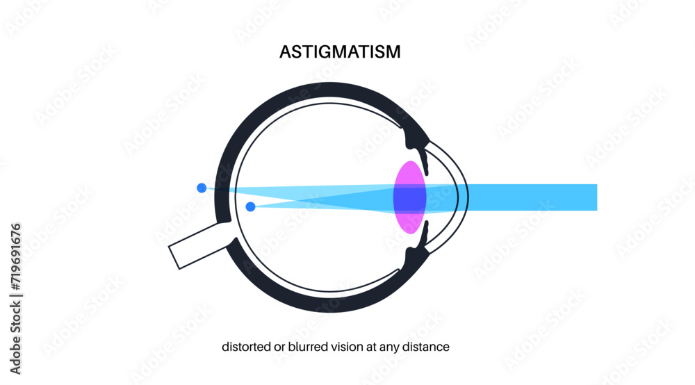 Astigmatism eye disease Astigmatism eye disease