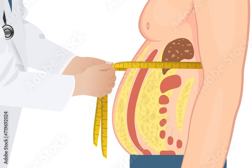 Abdominal fat surrounds the inner doors of the abdominal cavity. Overweight disease concept. Weight loss, liposuction, and diet.