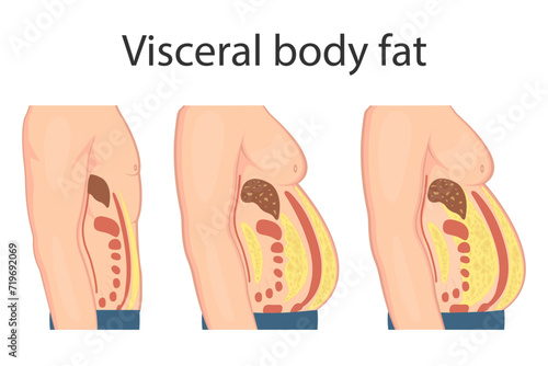 Medical poster about visceral fat. Abdominal fat surrounds the inner doors of the abdominal cavity. Overweight disease concept. Weight loss, liposuction, and diet.