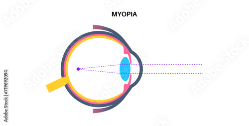 Nearsightedness eye disease
