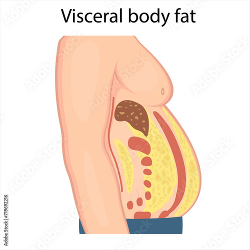 Medical poster about visceral fat. Abdominal fat surrounds the inner doors of the abdominal cavity. Overweight disease concept. Weight loss, liposuction, and diet.