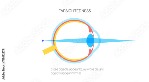 Farsightedness eye disease