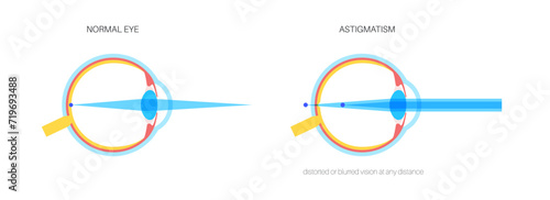 Astigmatism eye disease