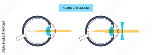 Normal eye and nearsightedness