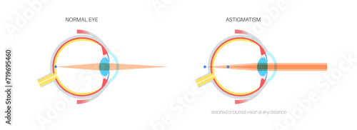 Astigmatism eye disease