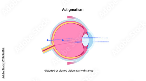 Astigmatism eye disease