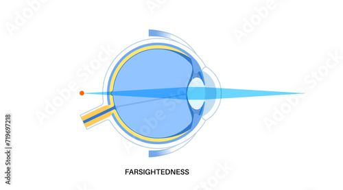 Farsightedness eye disease