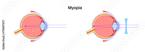 Normal eye and nearsightedness