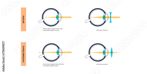 Astigmatism eye disease