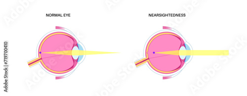 Normal eye and nearsightedness