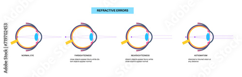 Refractive errors poster photo