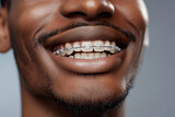 Man teeth with clear brackets and metal wires, closeup