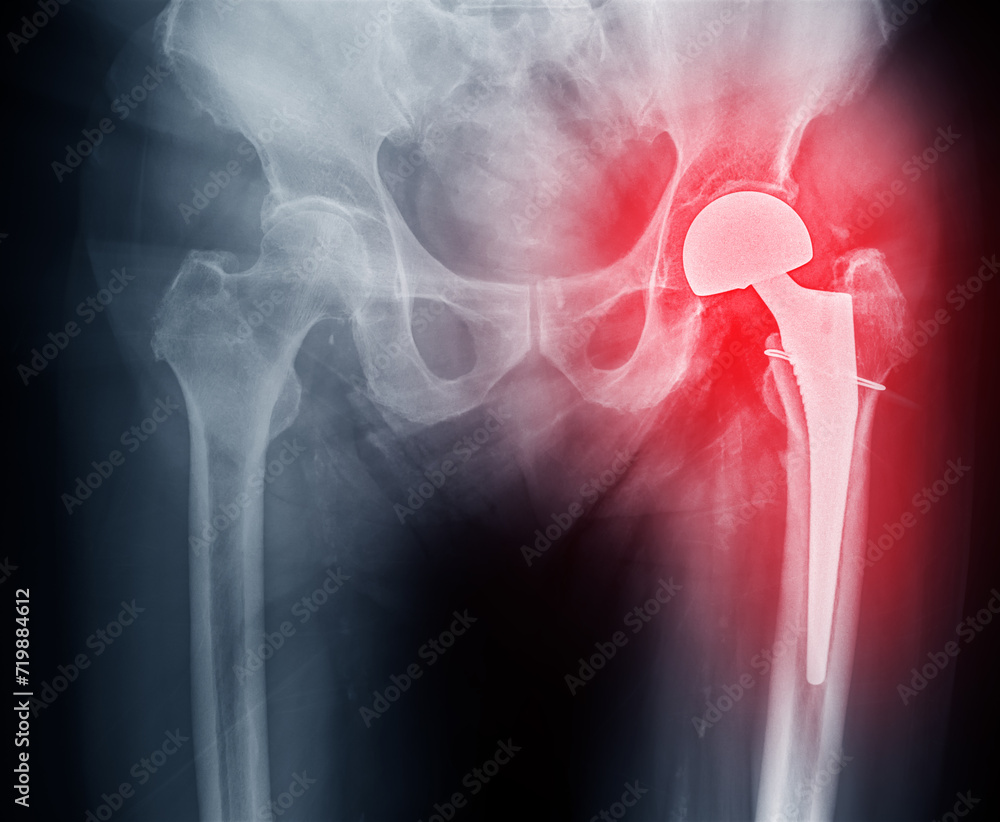 An Xray reveals both hip joints with TOTAL HIP ARTHROPLASTY