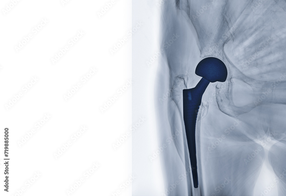 Fototapeta premium An X-ray reveals both hip joints with TOTAL HIP ARTHROPLASTY, showcasing the success of the surgical procedure and providing a visual testament to the restored mobility and function.
