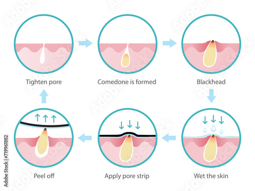 Life cycle of blackhead removal vector isolated on white background. Cross section of diagram blackhead pore skin, comedone is formed, expand to non inflammatory acne, treatment with pore strip.