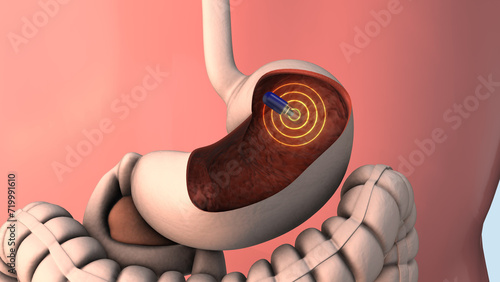 Obraz na płótnie Capsule endoscopy and wireless communication 