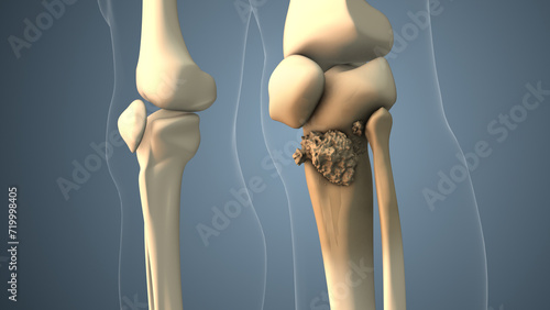 Cancer spreading along a leg bone