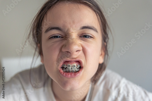 A funny teenage girl looks at the camera and demonstrates braces on her teeth.