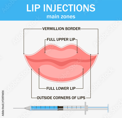 Lip injection hyaluronic acid filler. Hyaluronic acid lip injections scheme. Detailed anatomical zones infographic in colours. Medical, cosmetological and anti-aging concept. Vector illustration.