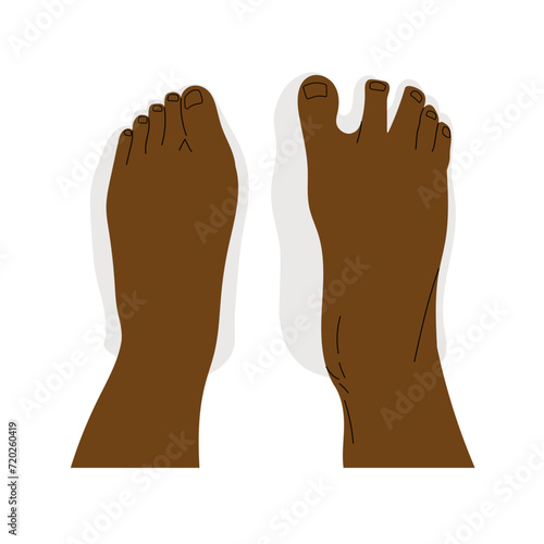 Top view comparison of healthy and deformed feet after wearing regular and barefoot shoes. Dark skin human feet. Vector illustration
