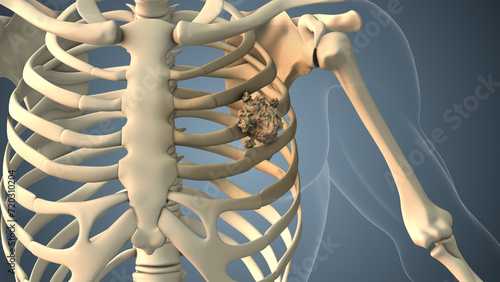 Cancer spreading along a rib bone photo