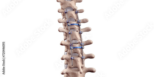 Spine Posterior Thoracic Fusion with Pedicle Screws and Rods on White Background
