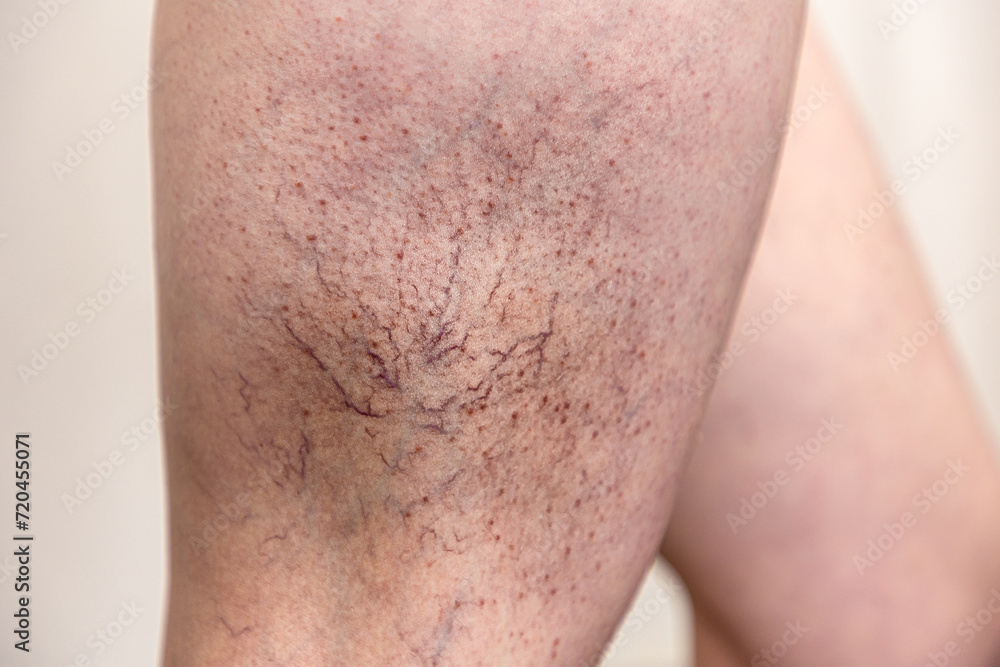 Fototapeta premium Close-up of woman's hip with veins and vascular asterisks. Concept of varicosity on female leg