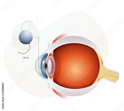 Intraocular Lens for Human Eye with Cataract - Illustration