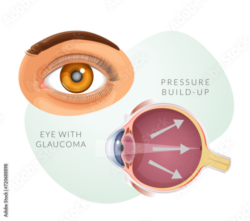 Human Eye with Glaucoma - Illustration