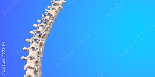Spine Posterior Thoracic Fusion with Pedicle Screws and Rods on Blue Background