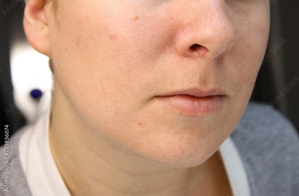Fototapeta premium Close up of caucasian woman's face with scars, acne skin problems