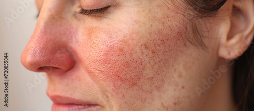 After successful rosacea treatment on a Caucasian woman's face, laser surgery removes redness and visible blood vessels. photo
